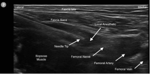 ilioinguinal nerve block ultrasound