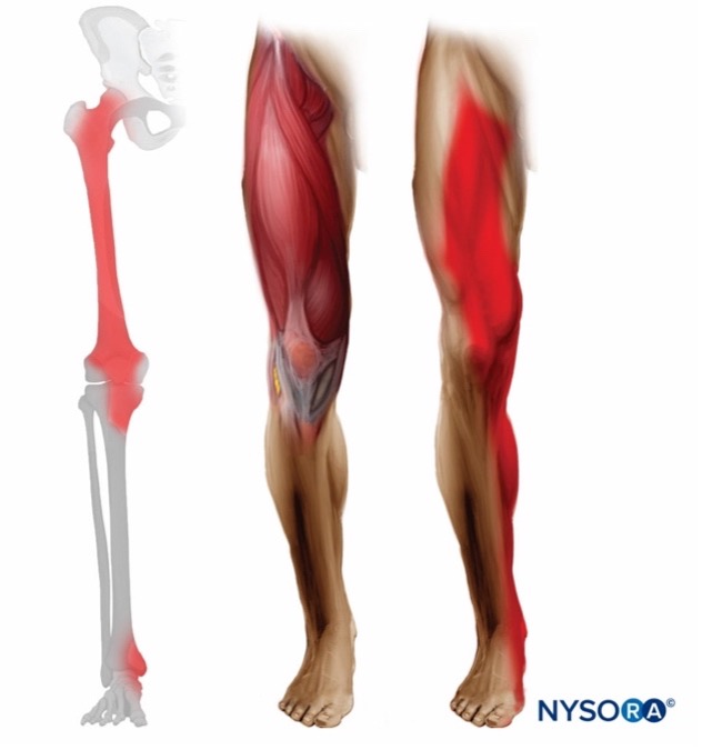 femoral nerve block distribution